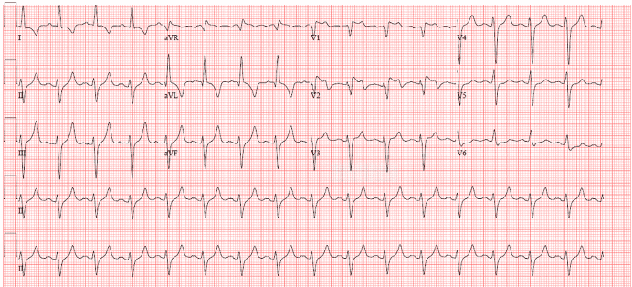 Old myocardial infarction q ECG