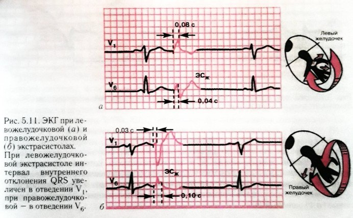 Atrial Flutter EKG