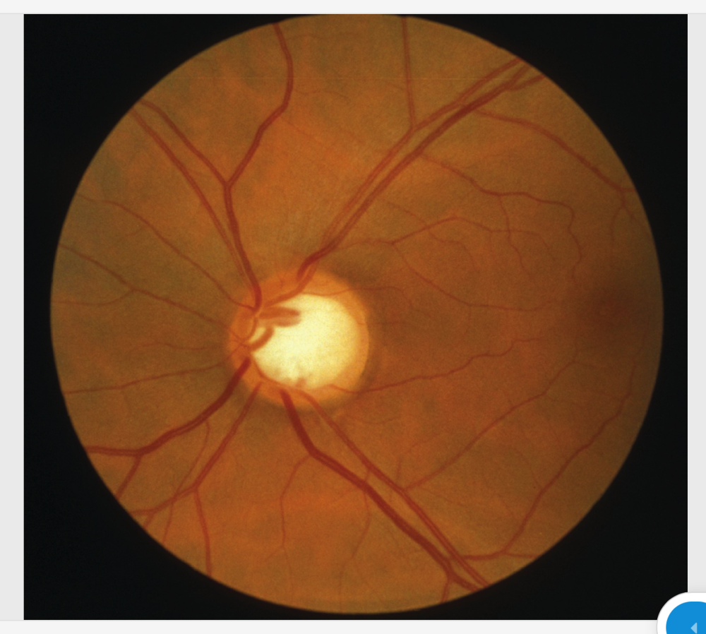 Differential diagnosis of open Angle Glaucoma