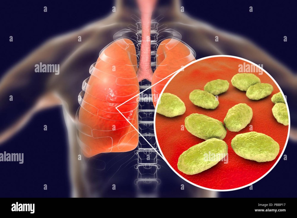 Haemophilus influenzae пневмония