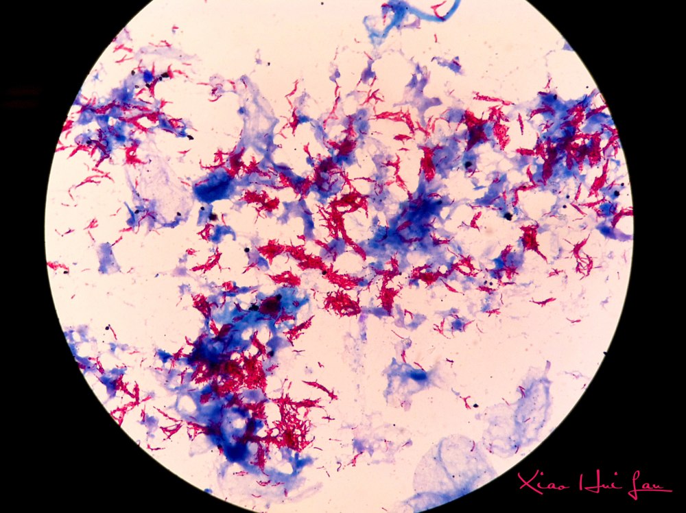 Mycobacterium tuberculosis в микроскопе
