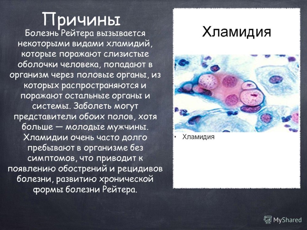 Клинические симптомы хламидиоза